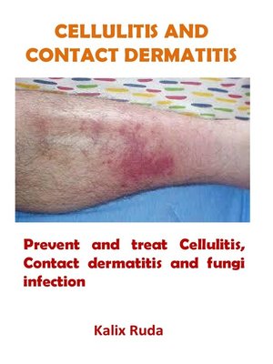 cover image of Cellulitis and Contact Dermatitis
